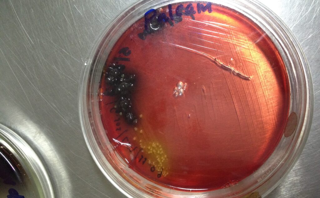 Silent Threat Unleashed: Navigating the Listeria Outbreak Impact—A Multifaceted Exploration